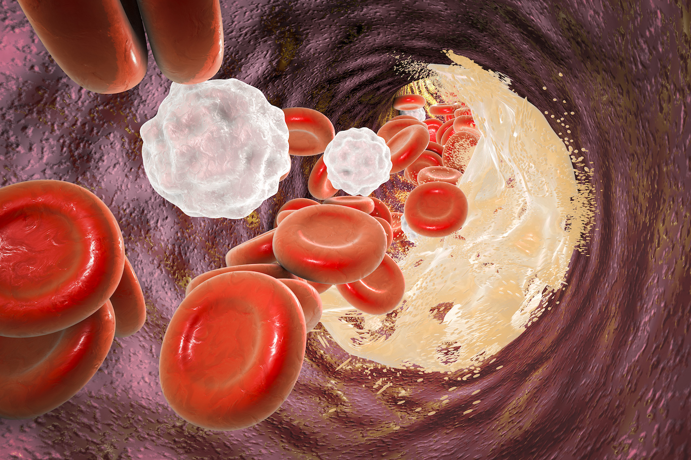 new-fda-report-highlights-risk-of-lung-blood-clots-from-drug-tofacitinib